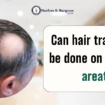 can-hair-transplant-be-done-on-alopecia-areata