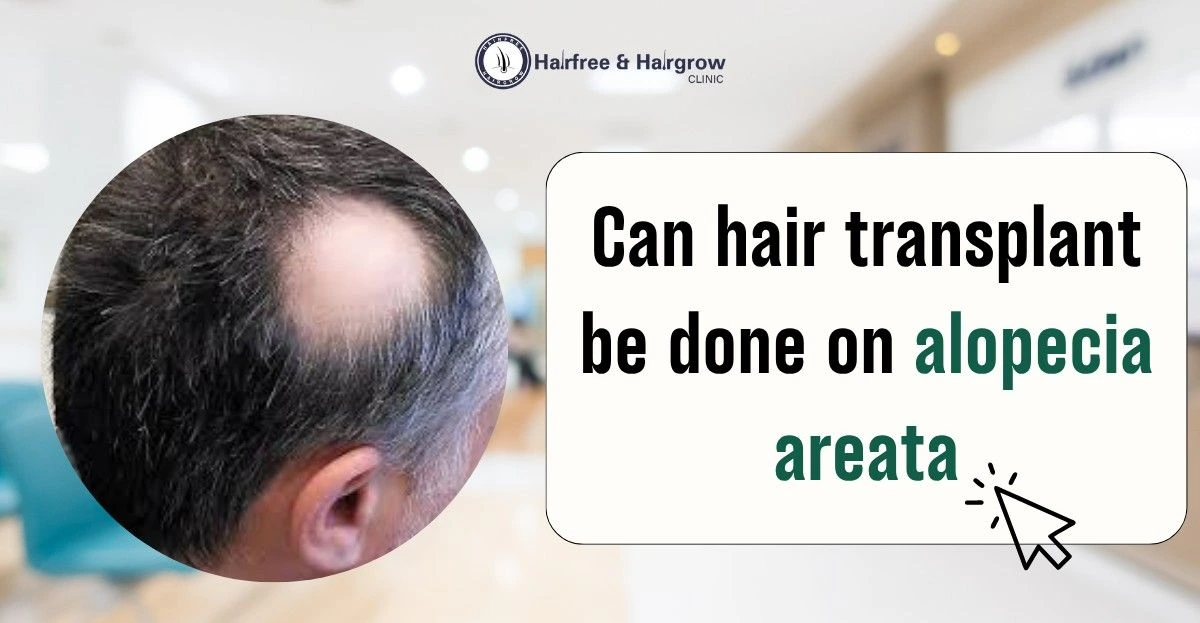 can-hair-transplant-be-done-on-alopecia-areata