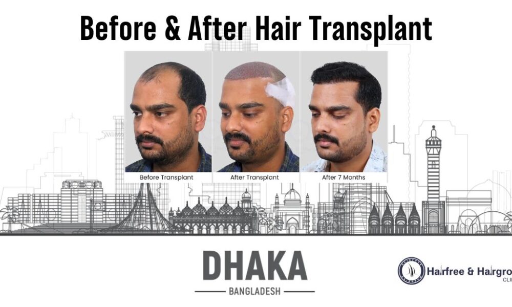 Before & After Hair Transplant in Dhaka – Real Results