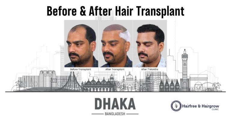 Before & After Hair Transplant in Dhaka – Real Results