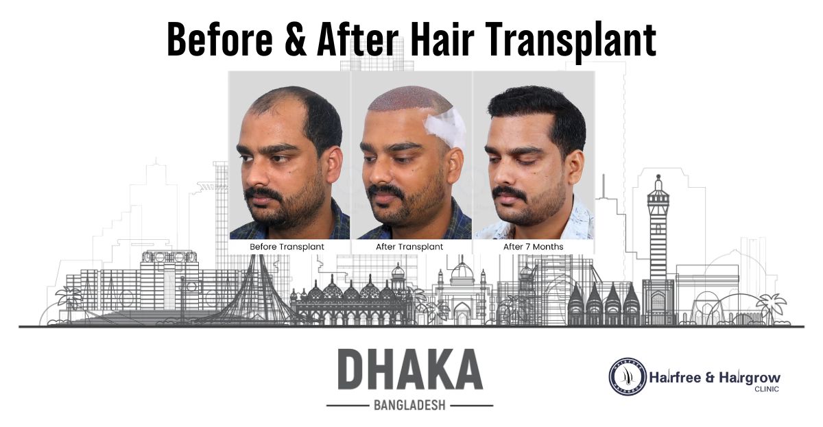 Before & After Hair Transplant in Dhaka – Real Results