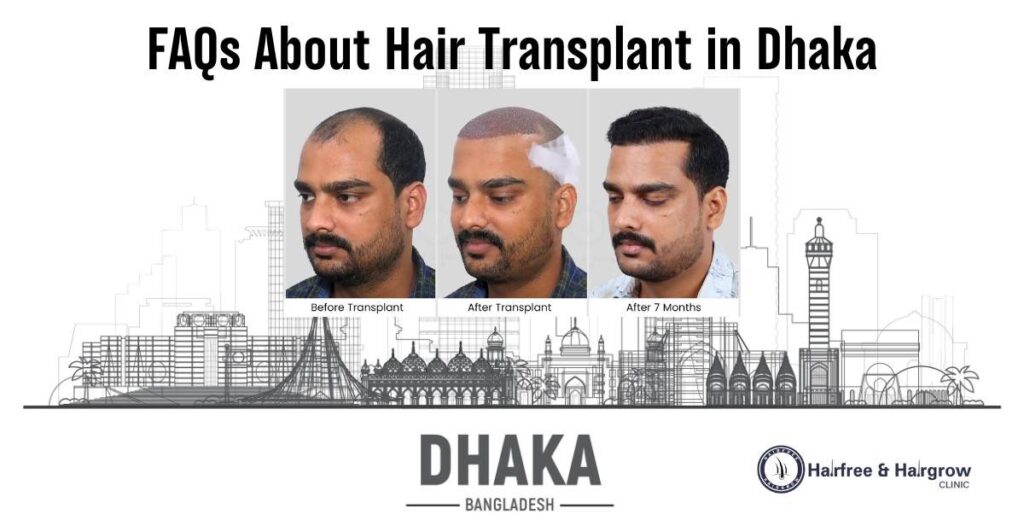 FAQs About Hair Transplant in Dhaka