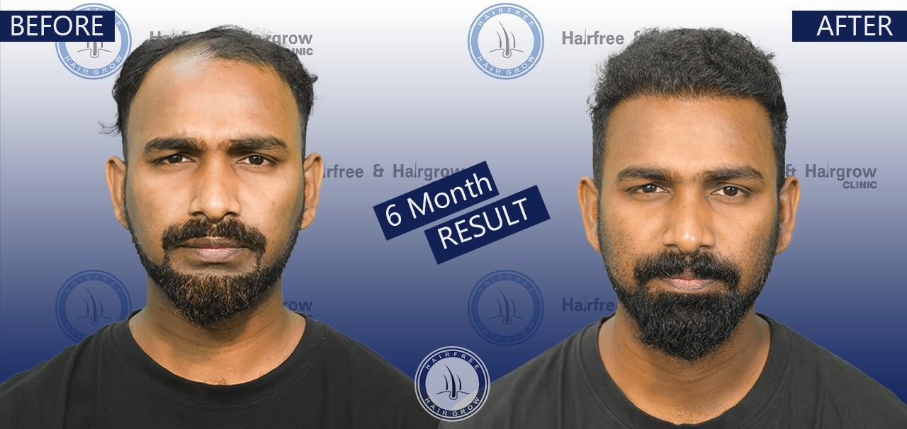 Arif 6 Month hair transplant before after