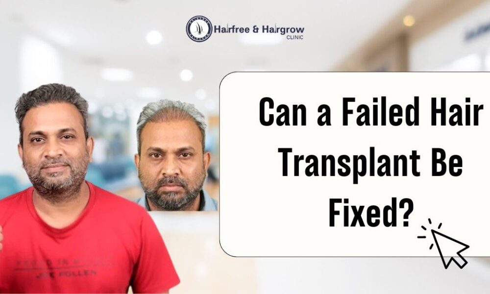 Can a Failed Hair Transplant Be Fixed