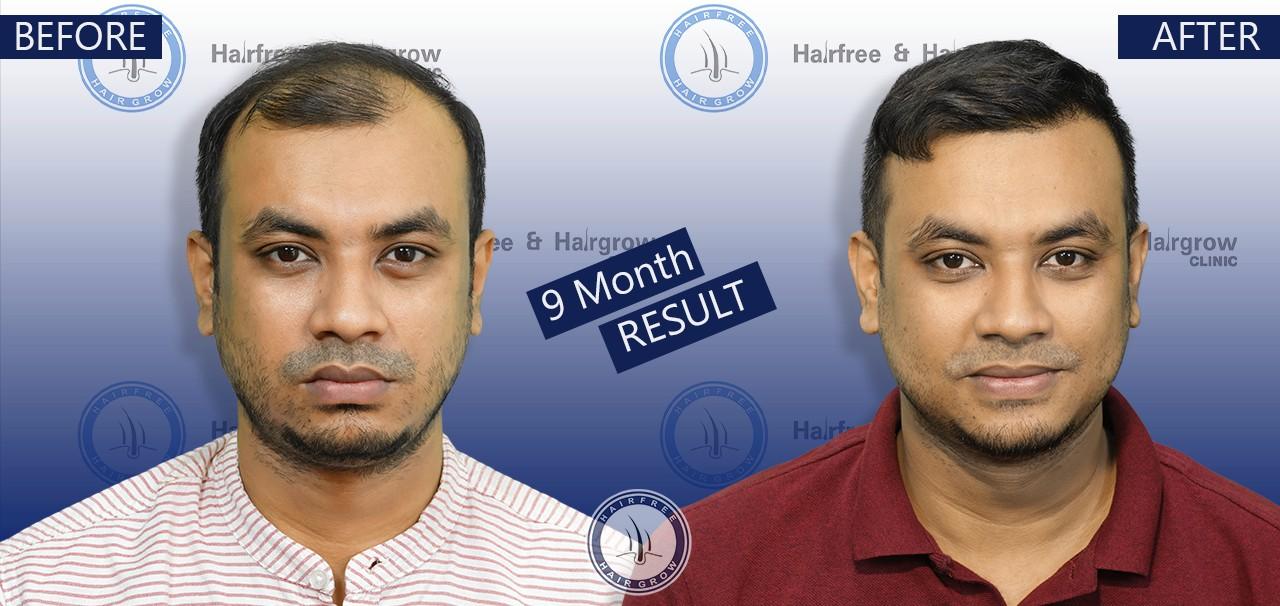 Kushal 09 Month hair transplant before after