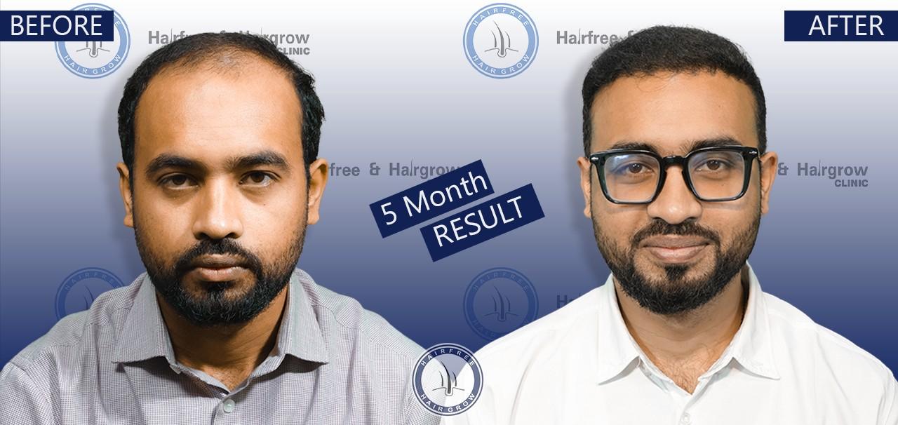 Mehedi 5 Month hair transplant before after