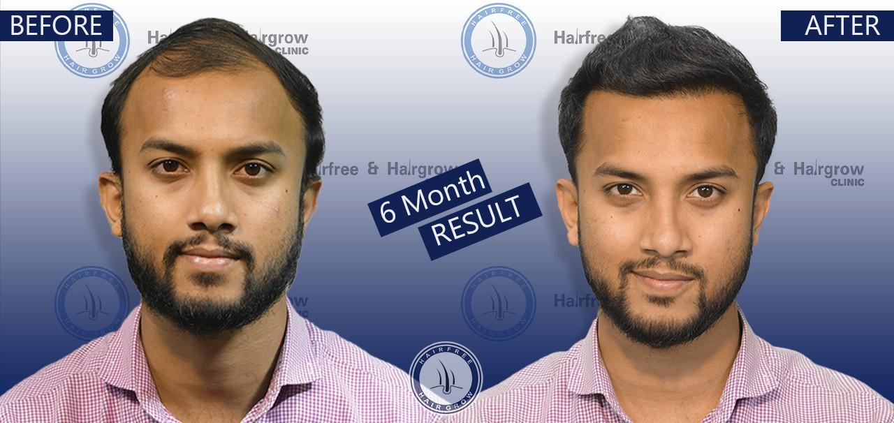 Pritul 6 Month hair transplant before after