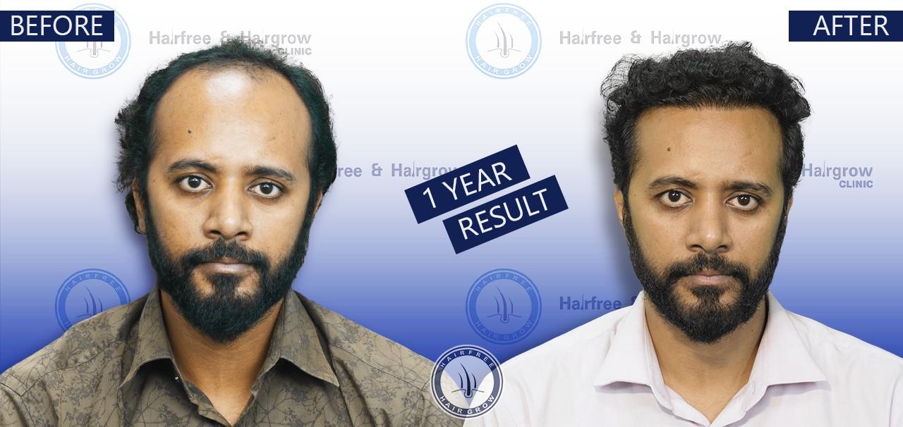 Sakil 1 Year hair transplant before after
