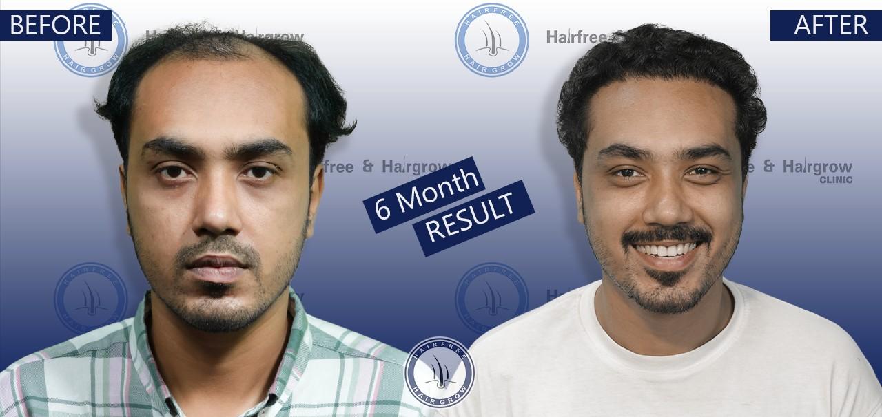 Tushar 6 Month hair transplant before after result