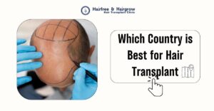 Which Country is Best for Hair Transplant