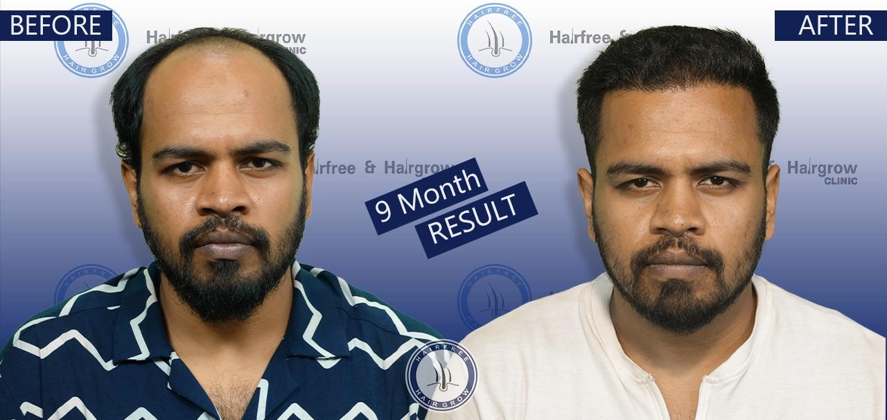 Yeasin 9 Month hair transplant before after result dhaka