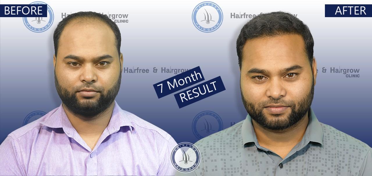 jahir 7 Month hair transplant before after