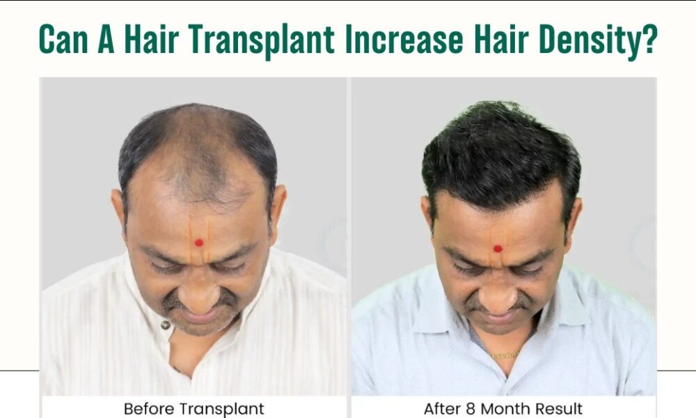 Can A Hair Transplant Increase Hair Density