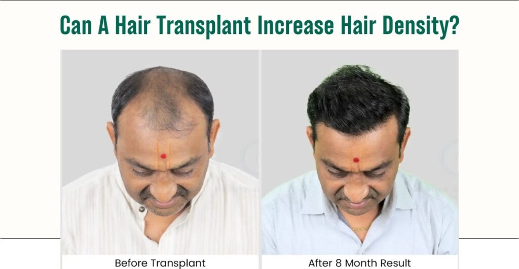 Can A Hair Transplant Increase Hair Density