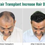 Can A Hair Transplant Increase Hair Density