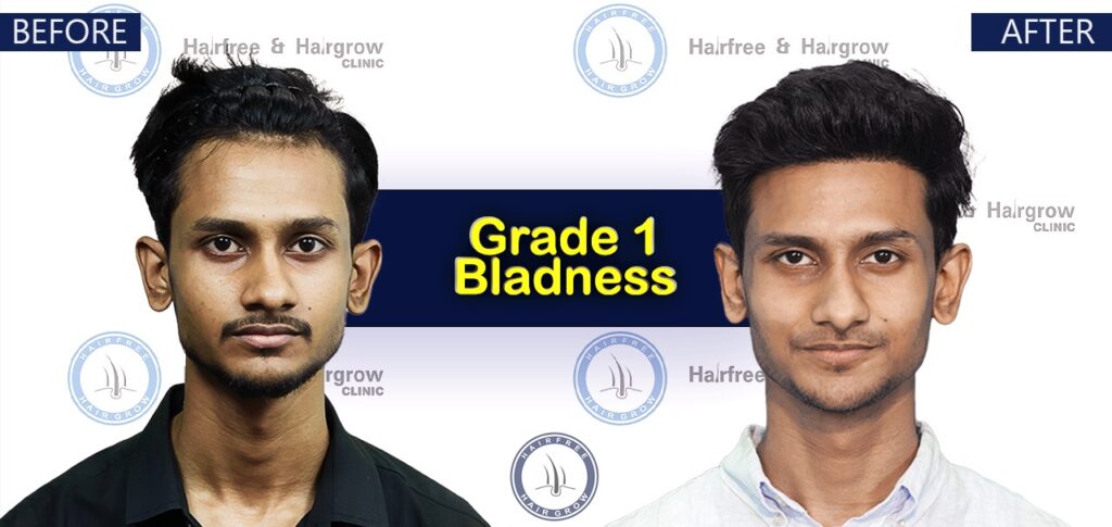 Dr. Naznin Nipa 2 Grade 1 Hair Transplant Cost