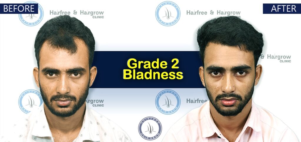 Dr. Naznin Nipa 3 Grade 2 Hair Transplant Cost