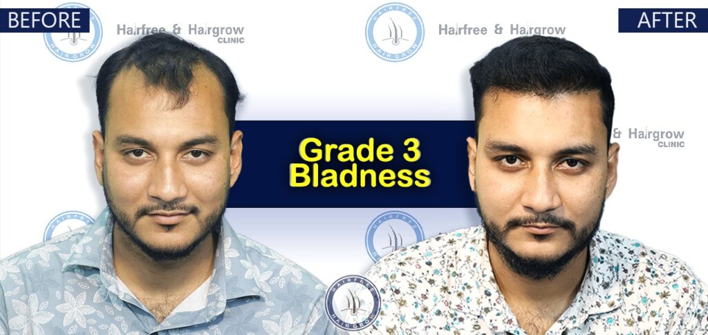Dr. Naznin Nipa 4 Grade 3 Hair Transplant Cost