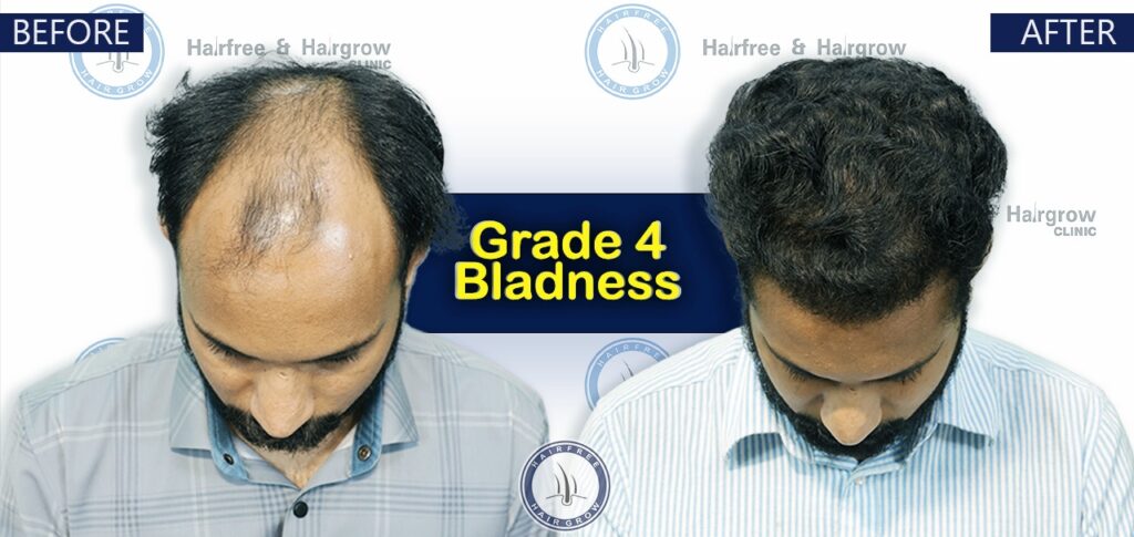 Dr. Naznin Nipa 5 Grade 4 Hair Transplant Cost