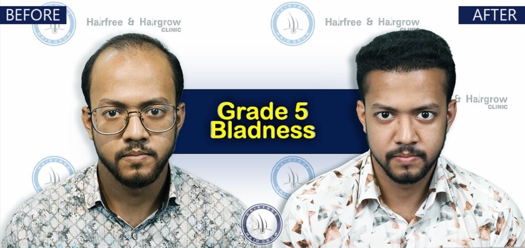 Dr. Naznin Nipa 6 Grade 5 Hair Transplant Cost