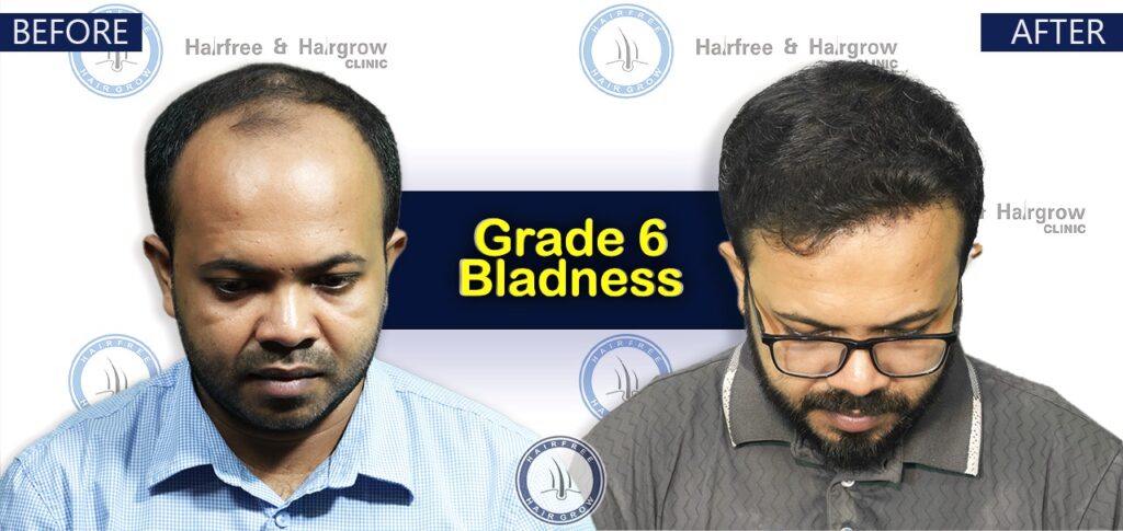 Dr. Naznin Nipa 7 Grade 6 Hair Transplant Cost