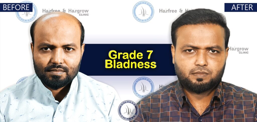 Dr. Naznin Nipa 8 Grade 7 Hair Transplant Cost