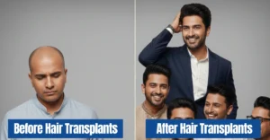 Why Celebrities Choose Hair Transplants