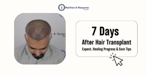 7 Days After Hair Transplant