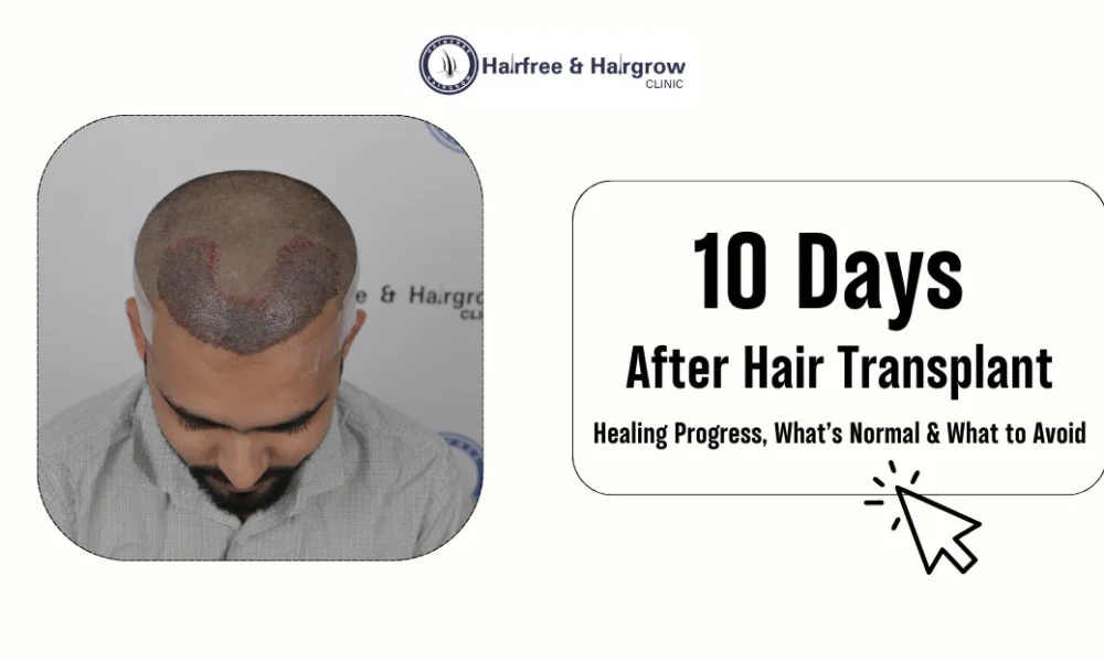 10 Days After Hair Transplant