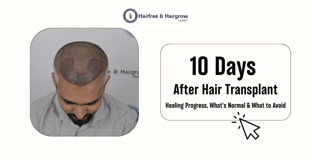 10 Days After Hair Transplant