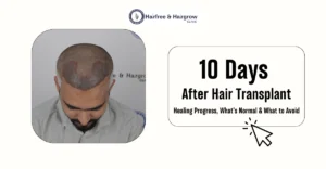 10 Days After Hair Transplant