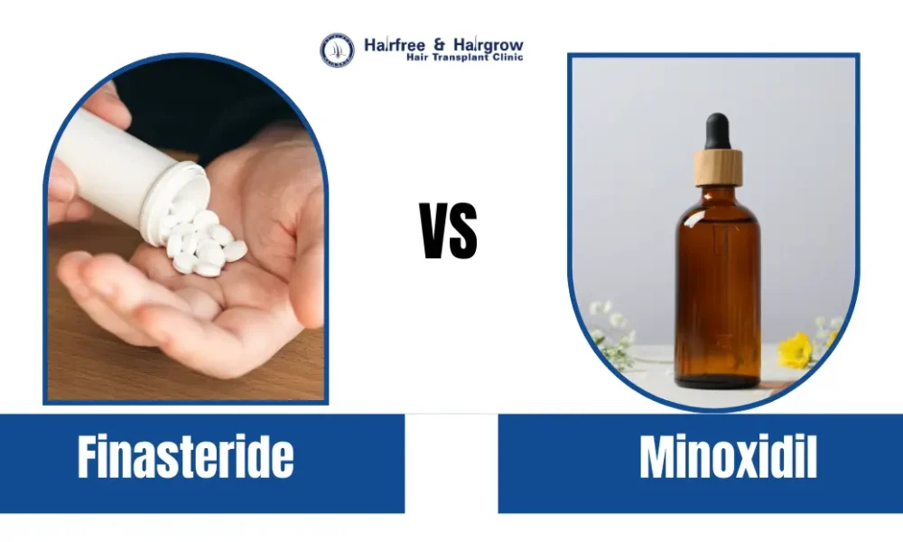 Finasteride vs Minoxidil