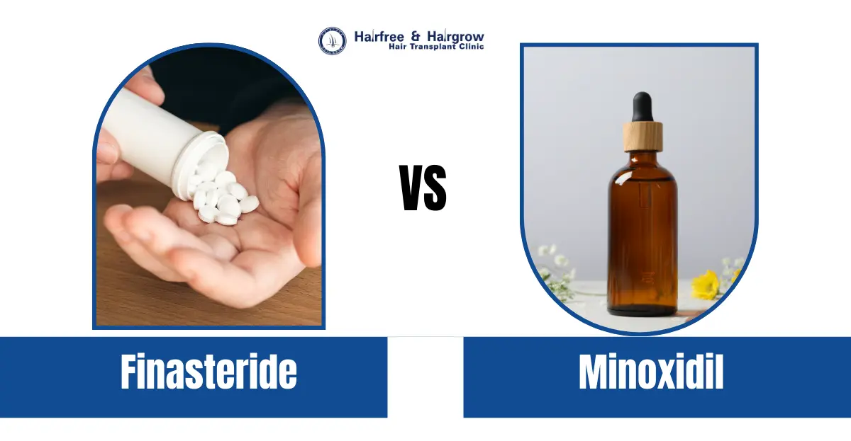 Finasteride vs Minoxidil