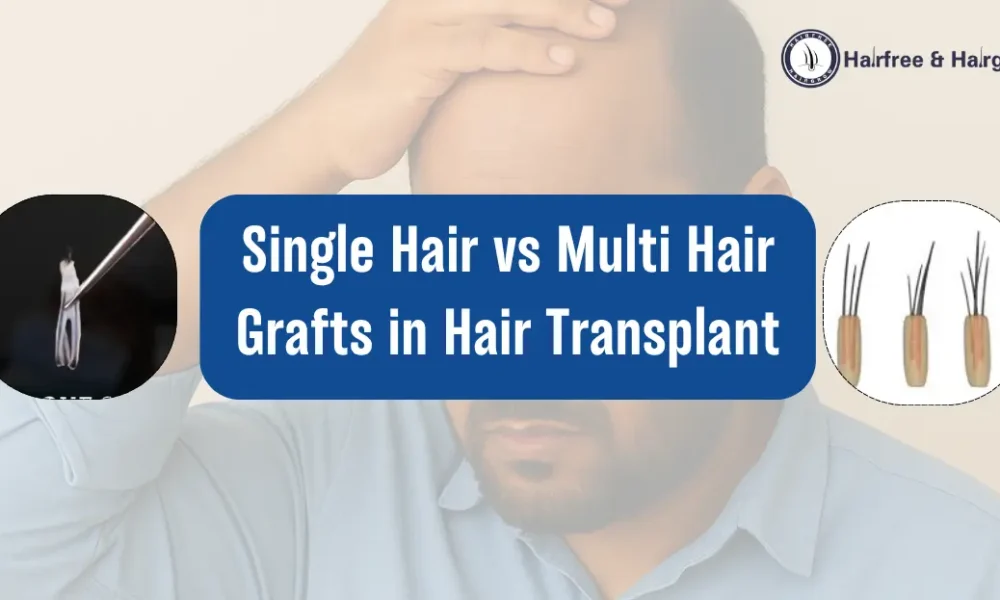 Single Hair vs Multi Hair Grafts in Hair Transplant