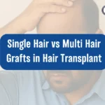 Single Hair vs Multi Hair Grafts in Hair Transplant