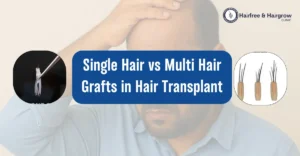 Single Hair vs Multi Hair Grafts in Hair Transplant