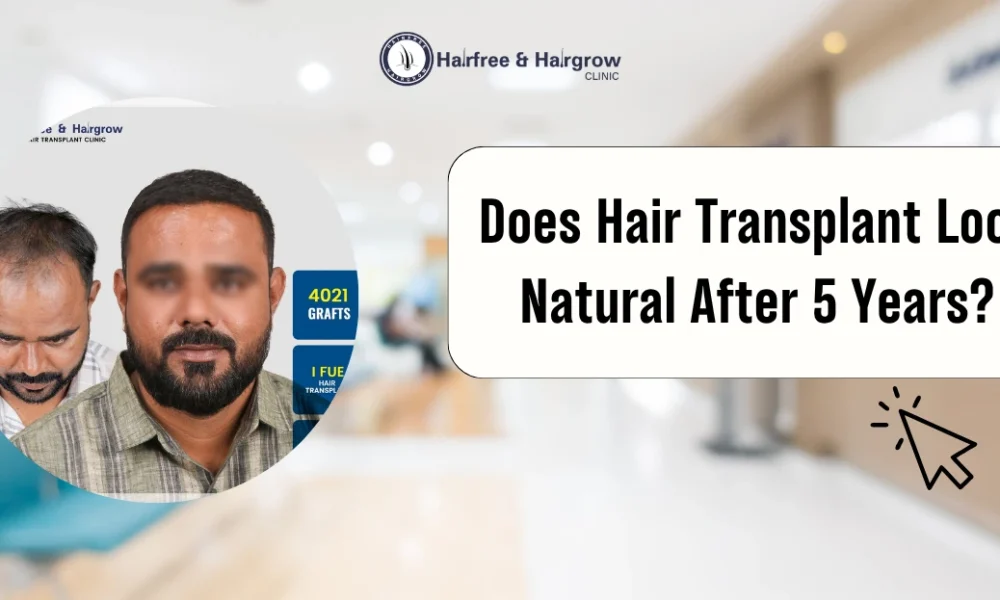 Does Hair Transplant Look Natural After 5 Years