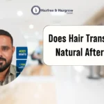 Does Hair Transplant Look Natural After 5 Years