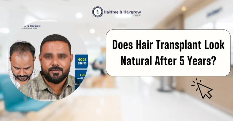 Does Hair Transplant Look Natural After 5 Years
