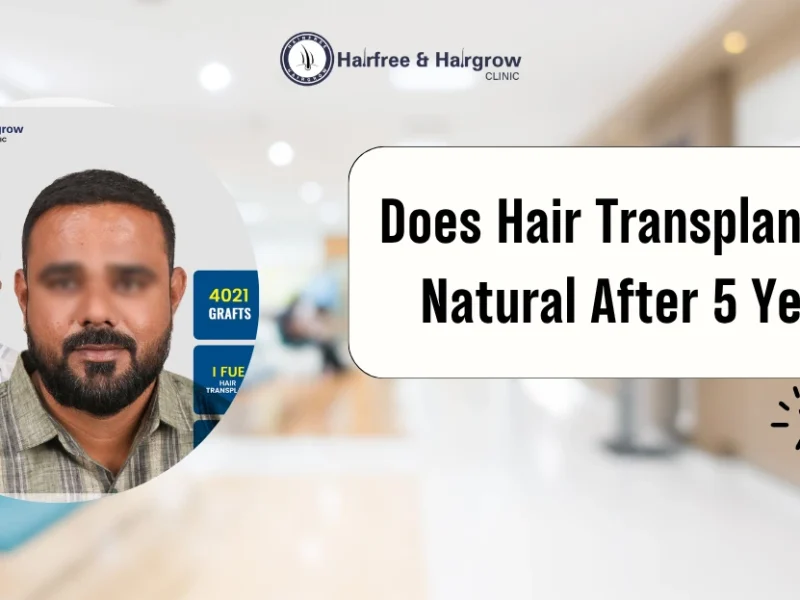 Does Hair Transplant Look Natural After 5 Years?