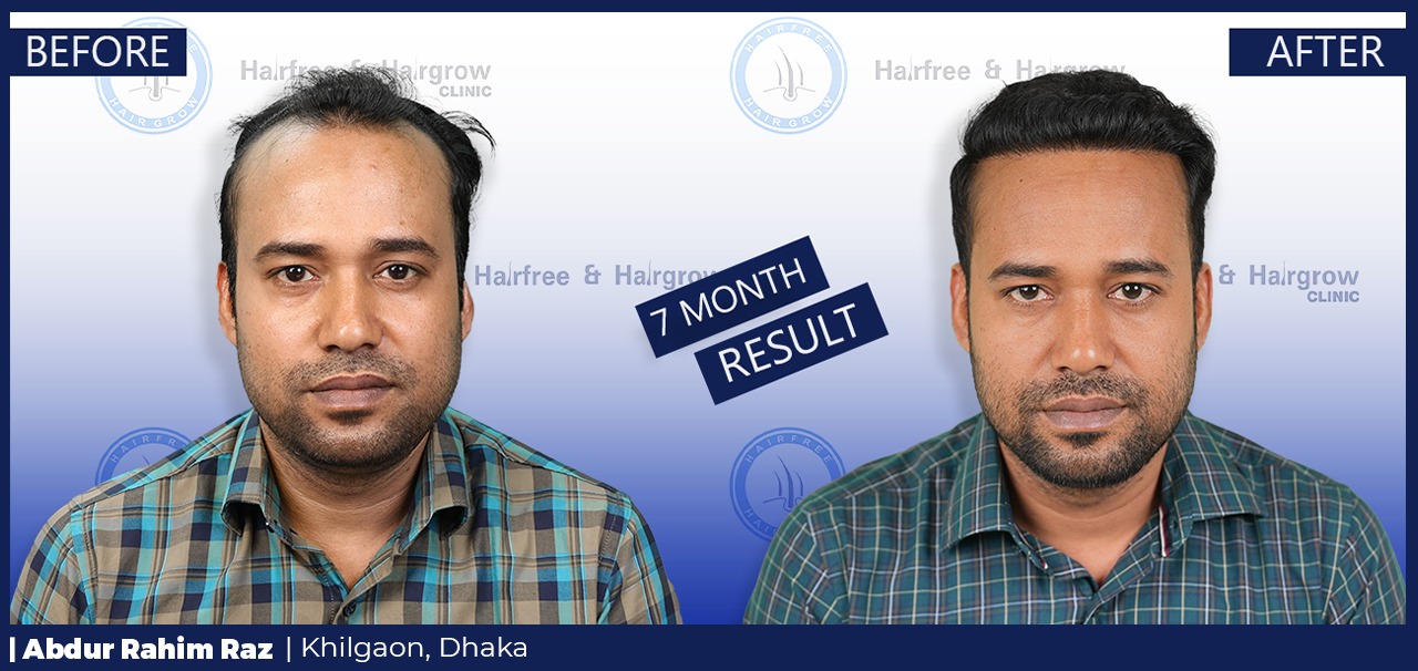 Abdur Rahim Raz 7 Month Hair Transplant Result in Dhaka, Bangladesh | Before & After FUE Hair Restoration