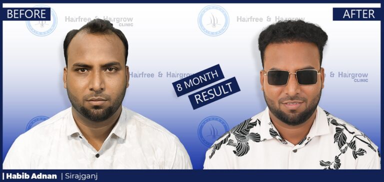 Habib Adnan 8 Month Hair Transplant Result in Bangladesh | Before and After FUE Hair Restoration