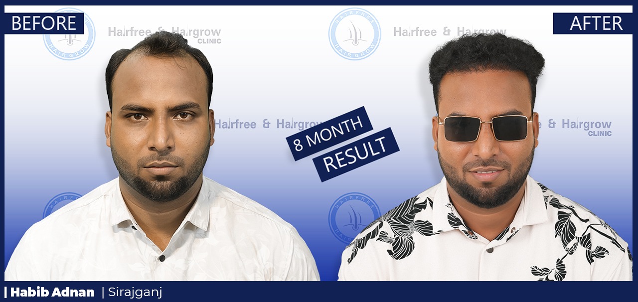 Habib Adnan 8 Month Hair Transplant Result in Bangladesh | Before and After FUE Hair Restoration