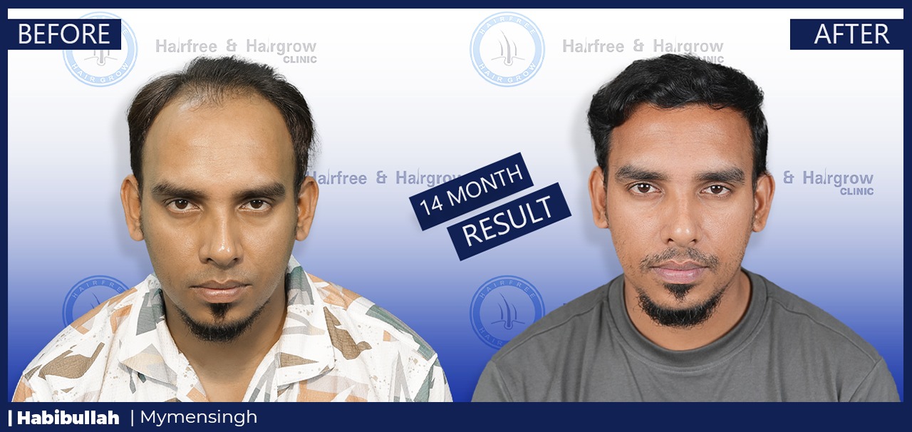 Habibullah 14 Month Hair Transplant Result in Bangladesh | Before and After FUE Hair Restoration