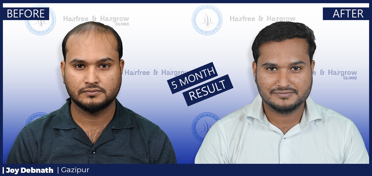 5 Month Hair Transplant Result in Bangladesh | Joy Debnath Hair Restoration Journey