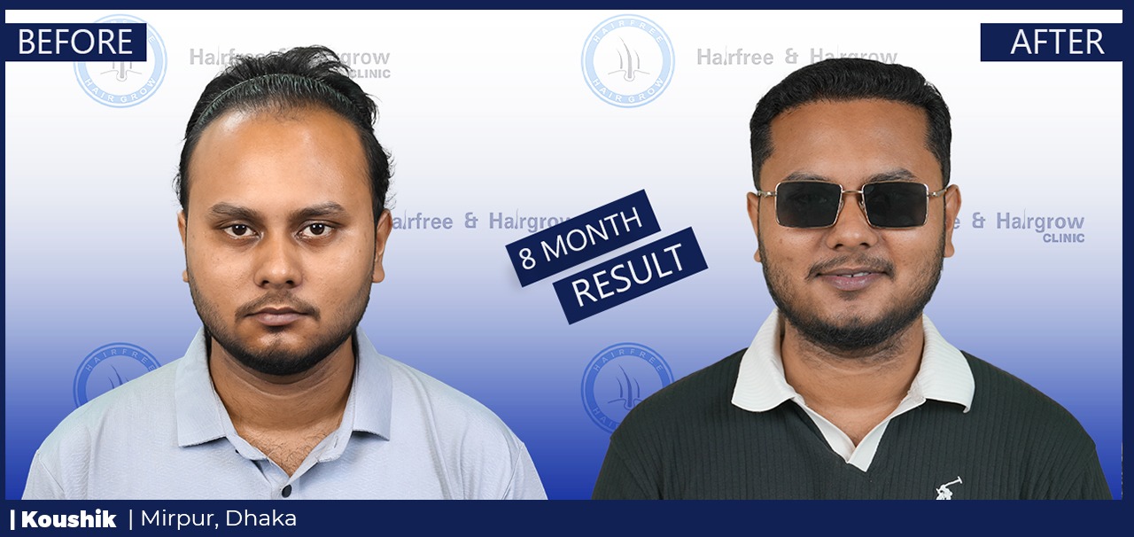 Koushik 8 Month Hair Transplant Result in Dhaka, Bangladesh | Before and After FUE Hair Restoration