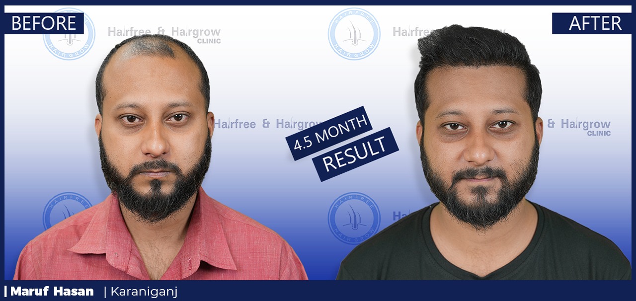 Maruf Hasan 4.5 Month Hair Transplant Result in Bangladesh | Before & After Hair Restoration