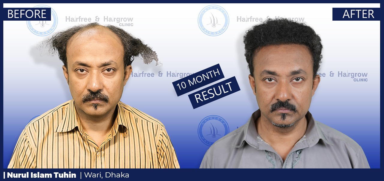 Nurul Islam Tuhin 10 Month Hair Transplant Result in Dhaka, Bangladesh | Before and After FUE Hair Restoration
