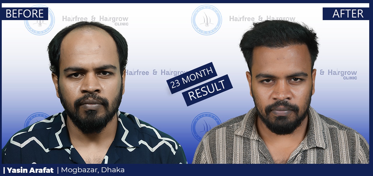 Yasin Arafat 23 Month Hair Transplant Result in Dhaka, Bangladesh | Before and After FUE Hair Restoration