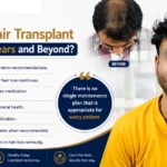 How Can You Maintain Hair Transplant Results for 5 Years